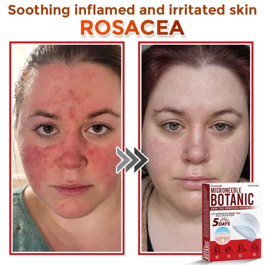 CvreozÂŽ MicroNeedle Botanic Skin Tag Removal Patch đşđ¸ Made in the USA
