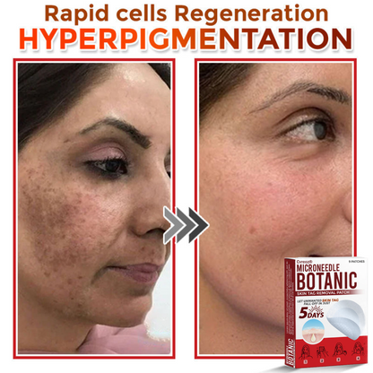 Cvreoz® MicroNeedle Botanic Skin Tag Removal Patch 🇺🇸 Made in the USA