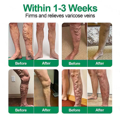 🗽👩‍⚕️👍Healrize® VeinTarget Microneedle Patch⚡Instant Relief, Long-Term Results