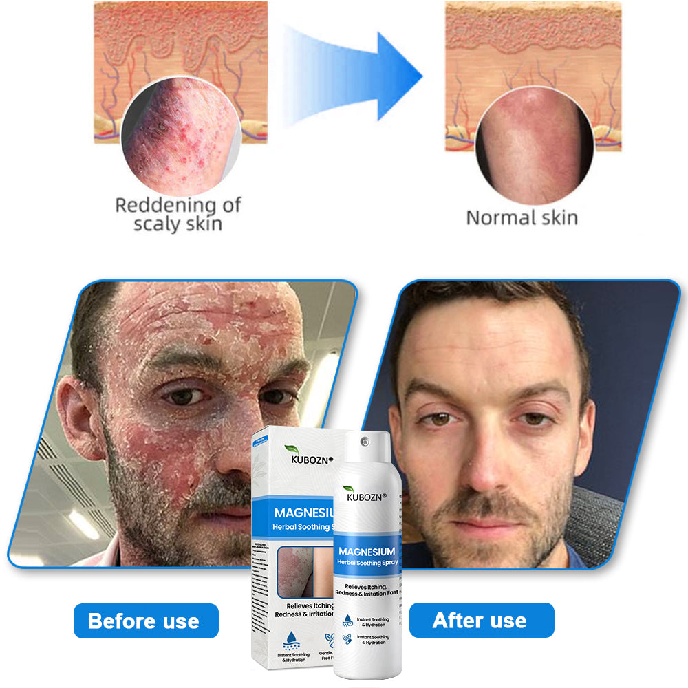 FDA Certified⚕️ KUBOZN® Magnesium Herbal Psoriasis Spray ⚡3-MINUTE RELIEF