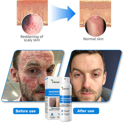 FDA Certified⚕️ KUBOZN® Magnesium Herbal Psoriasis Spray ⚡3-MINUTE RELIEF