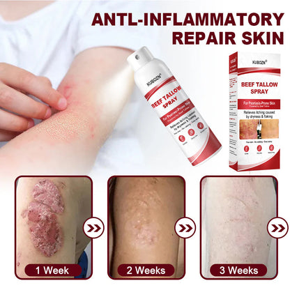 KUBOZN® Beef Tallow Spray — The No-Rub Relief for Psoriasis-Prone Skin✨