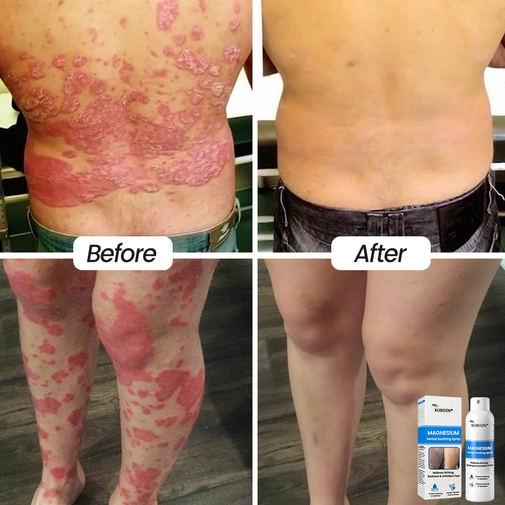 FDA Certified⚕️ KUBOZN® Magnesium Herbal Psoriasis Spray ⚡3-MINUTE RELIEF