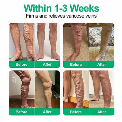 👨‍⚕️🔥Healrize® VeinEase Microneedle Care Patch(offer)