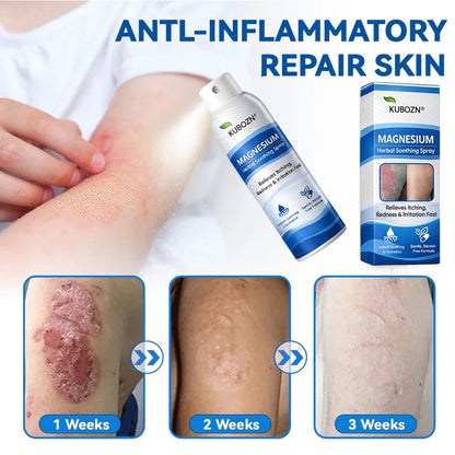 𝗢𝗳𝗳𝗶𝗰𝗶𝗮𝗹 𝗦𝘁𝗼𝗿𝗲 | FDA Certified⚕️ KUBOZN® Magnesium Herbal Psoriasis Spray ⚡3-MINUTE RELIEF