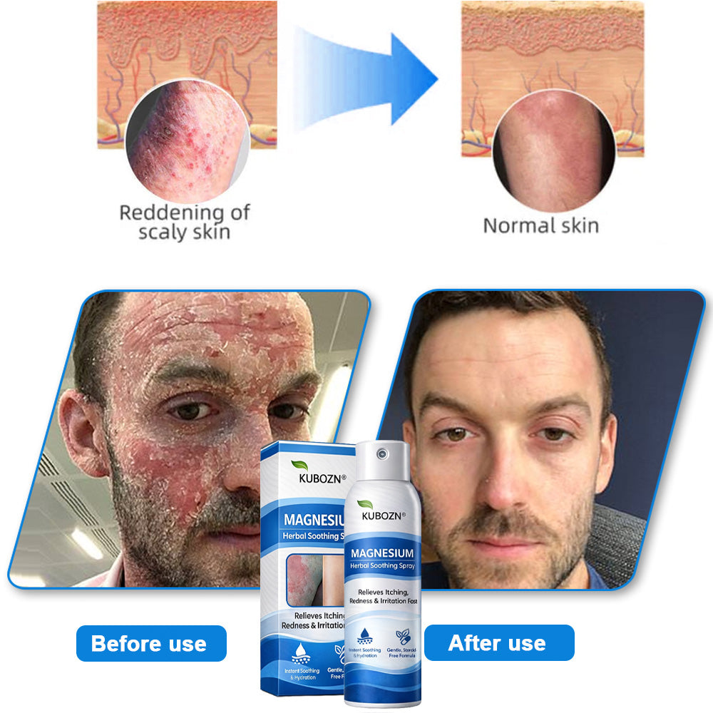 𝗢𝗳𝗳𝗶𝗰𝗶𝗮𝗹 𝗦𝘁𝗼𝗿𝗲 | FDA Certified⚕️ KUBOZN® Magnesium Herbal Psoriasis Spray ⚡3-MINUTE RELIEF
