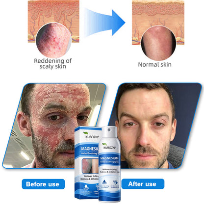 𝗢𝗳𝗳𝗶𝗰𝗶𝗮𝗹 𝗦𝘁𝗼𝗿𝗲 | FDA Certified⚕️ KUBOZN® Magnesium Herbal Psoriasis Spray ⚡3-MINUTE RELIEF