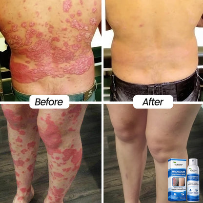 𝗢𝗳𝗳𝗶𝗰𝗶𝗮𝗹 𝗦𝘁𝗼𝗿𝗲 | FDA Certified⚕️ KUBOZN® Magnesium Herbal Psoriasis Spray ⚡3-MINUTE RELIEF