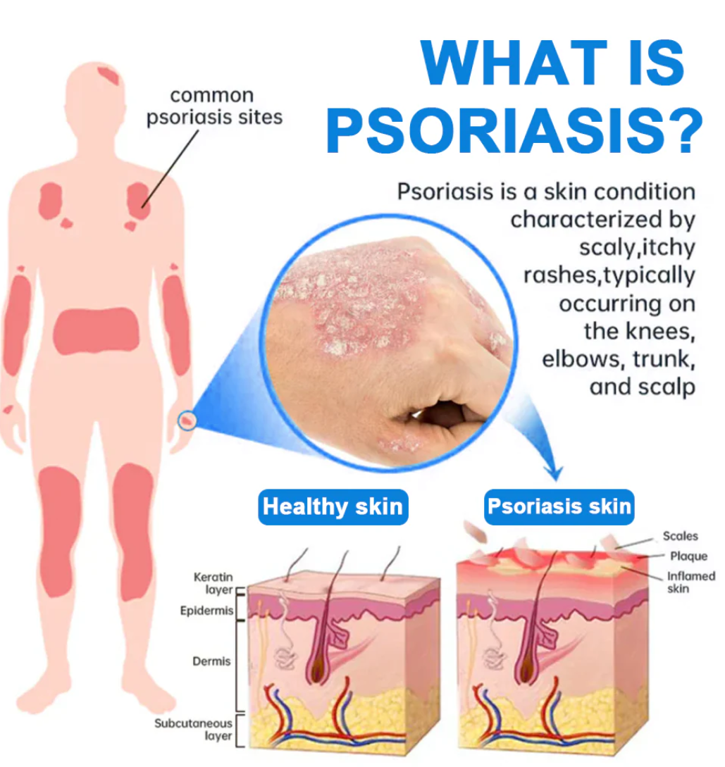 FDA Certified⚕️ KUBOZN® Magnesium Herbal Psoriasis Spray ⚡3-MINUTE RELIEF
